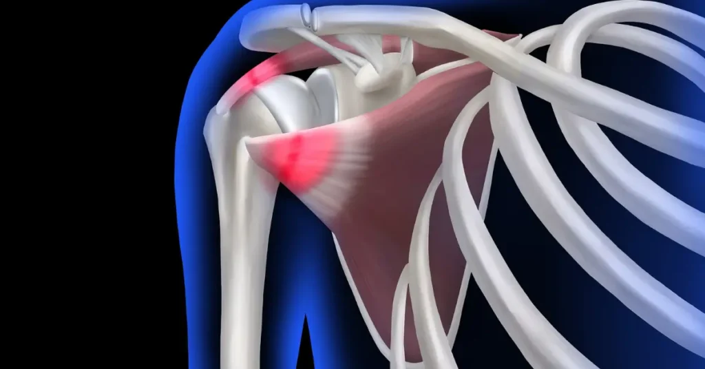 Are Push-Ups Wrecking Your Shoulders