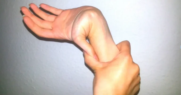 Hyper-Flexibility From Ehlers-Danlos Syndrome