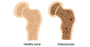 Blog Photo - How One Woman Reversed Osteoporosis Through Strength Training